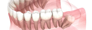 santa rosa wisdom tooth extraction