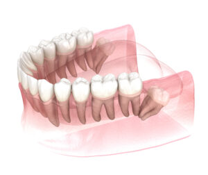 santa rosa wisdom tooth extraction