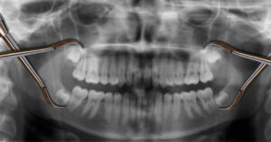 rohnert park wisdom tooth extraction