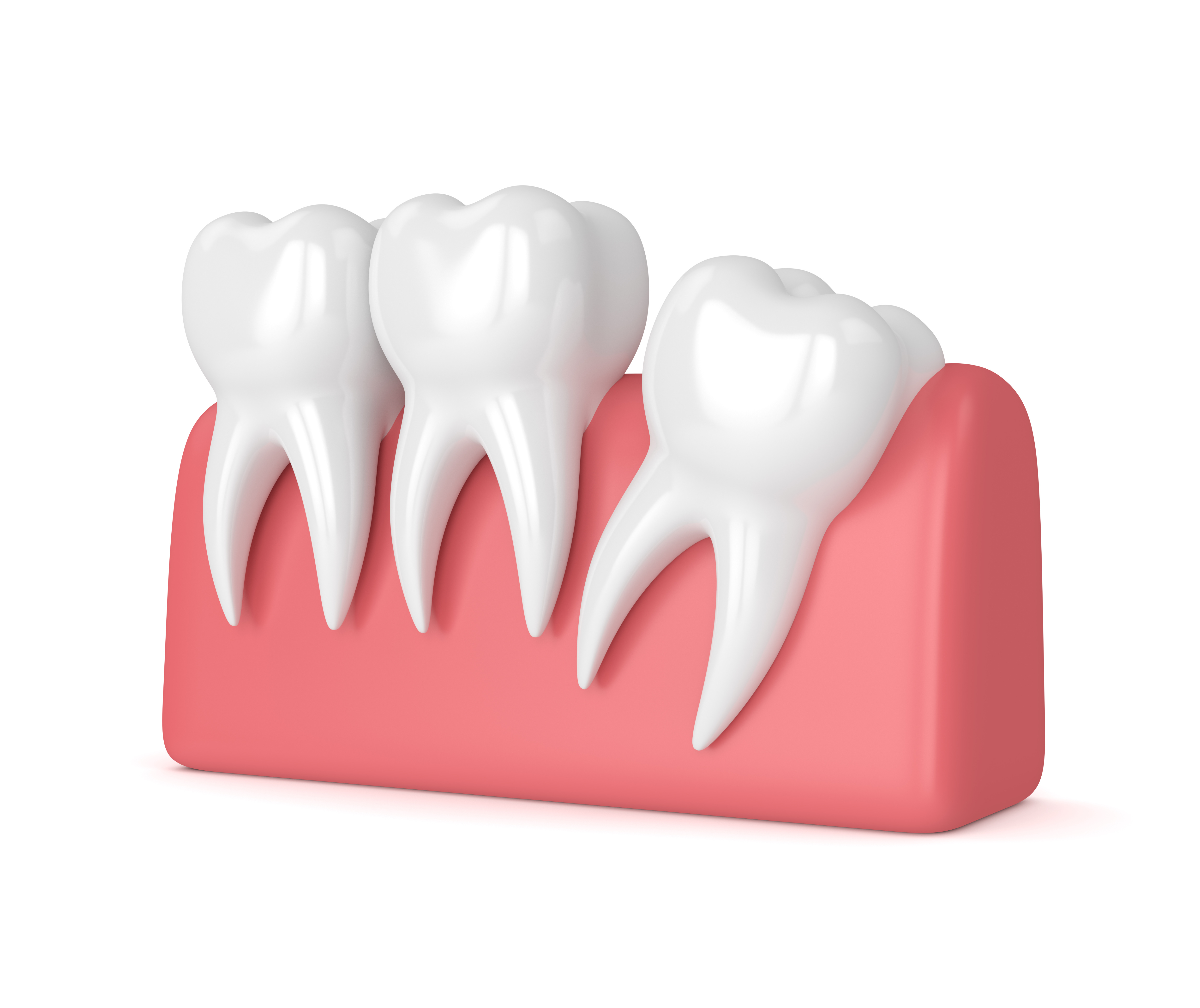Are Wisdom Teeth A Problem Santa Rosa And Rohnert Park Oral Surgery