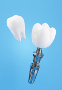 santa rosa dental implants