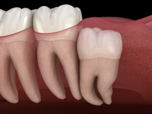 rohnert park wisdom teeth