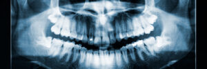 rohnert park tooth extraction