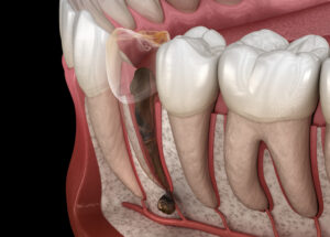 santa rosa tooth extraction