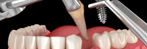 santa rosa dental implants