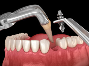 santa rosa dental implants