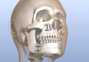 santa rosa jaw surgery