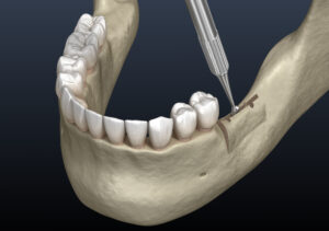 rohnert park ridge augmentation