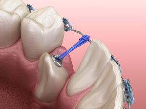 rohnert part impacted teeth