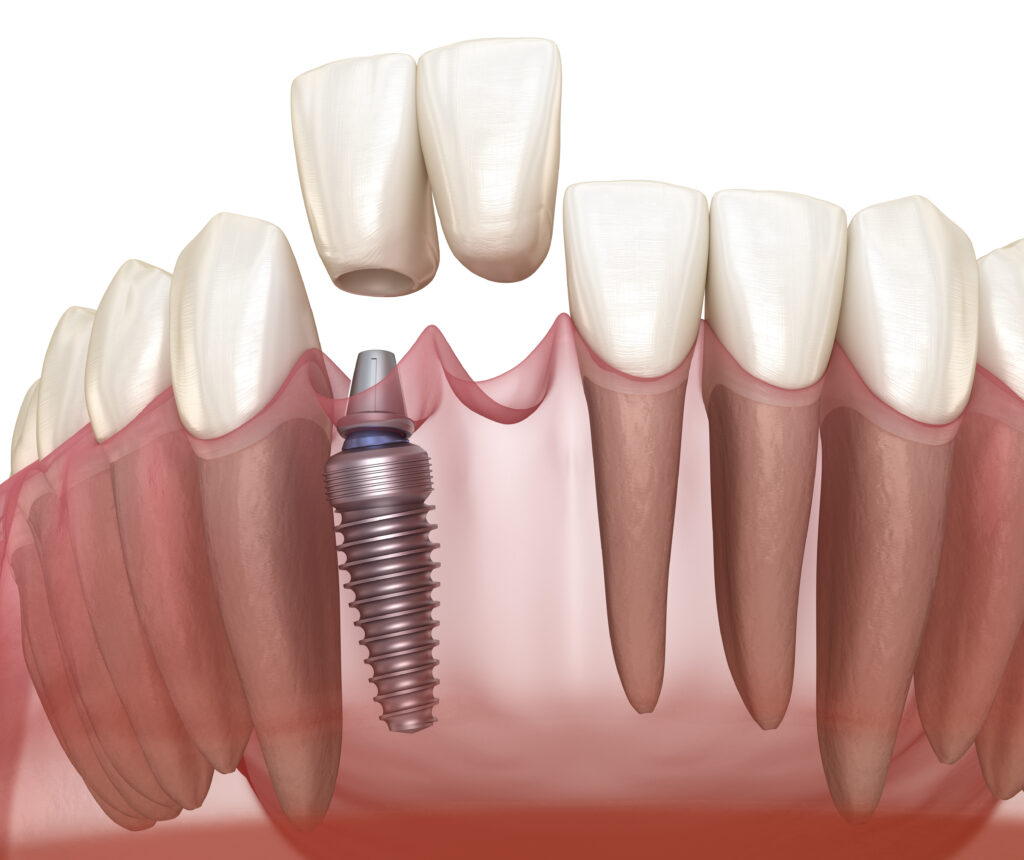 Ensuring Implant Placement Is Comfortable Santa Rosa Oral Surgery
