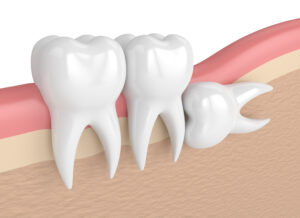 santa rosa wisdom tooth