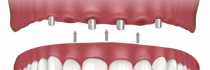 santa rosa all-on-four dentures
