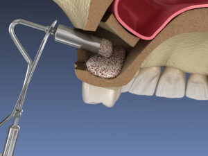 santa rosa jawbone grafting