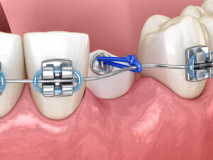 santa rosa bracketing teeth