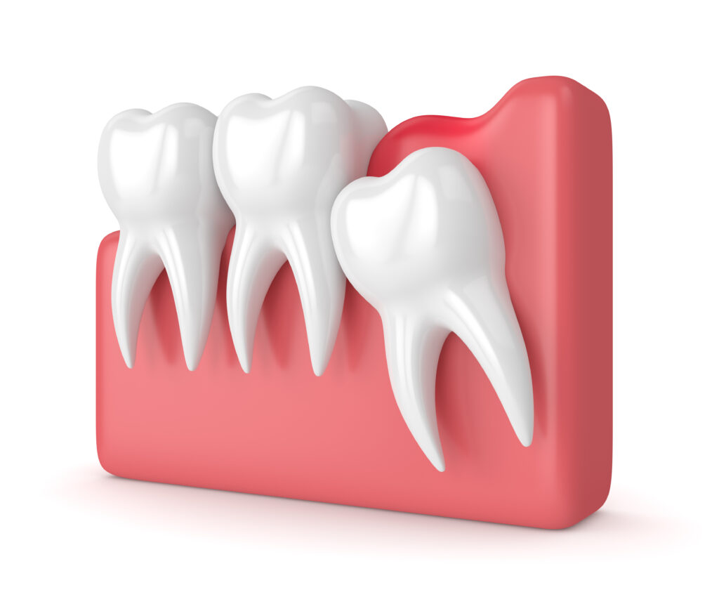 How Removing Wisdom Teeth Preserves Smiles | Santa Rosa Oral Surgery