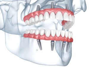 santa rosa oral surgery