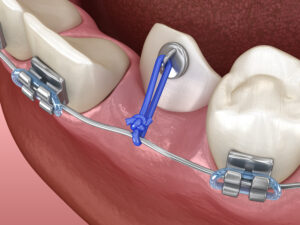 santa rosa bracketing teeth