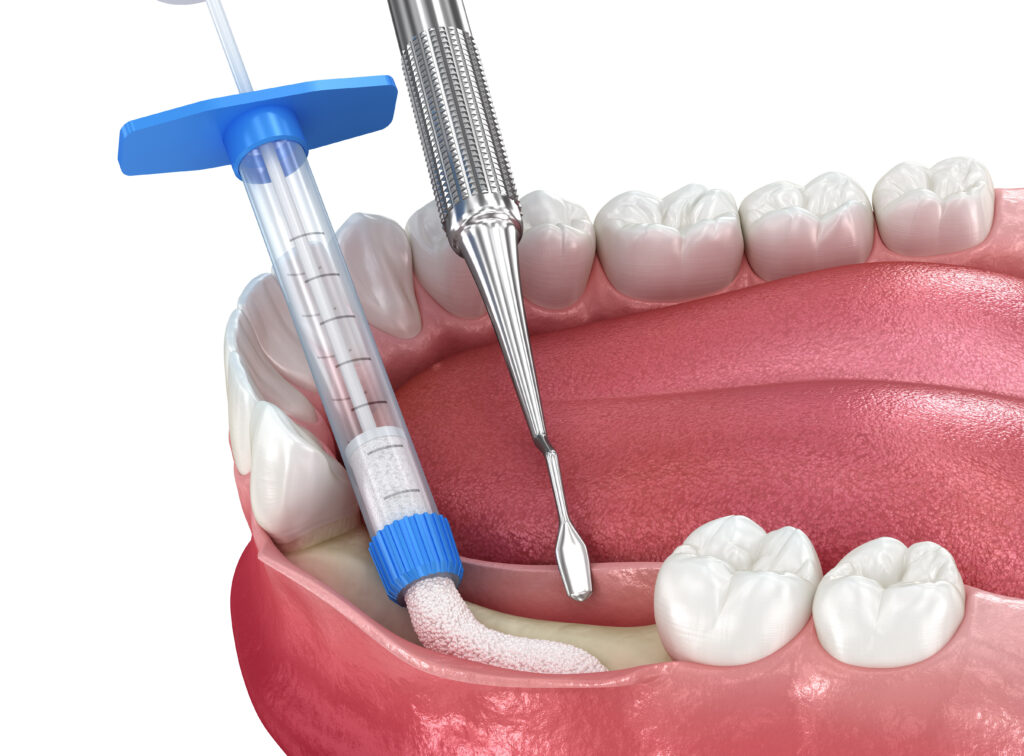 santa rosa jawbone grafting