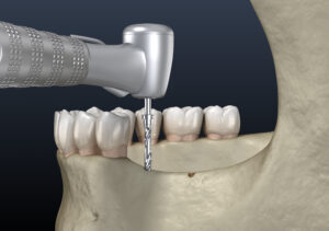 sabta rosa ridge augmentation