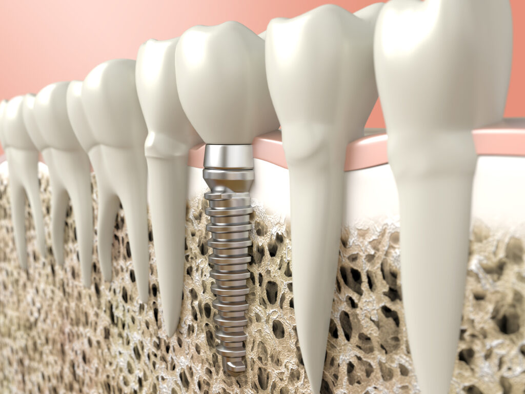 santa rosa dental implants