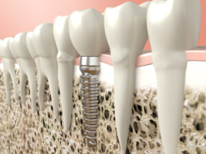 santa rosa dental implants