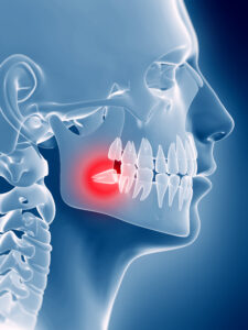 santa rosa tooth extraction