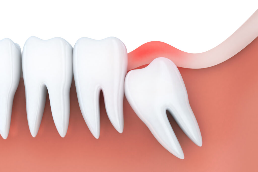 santa rosa wisdom tooth extraction