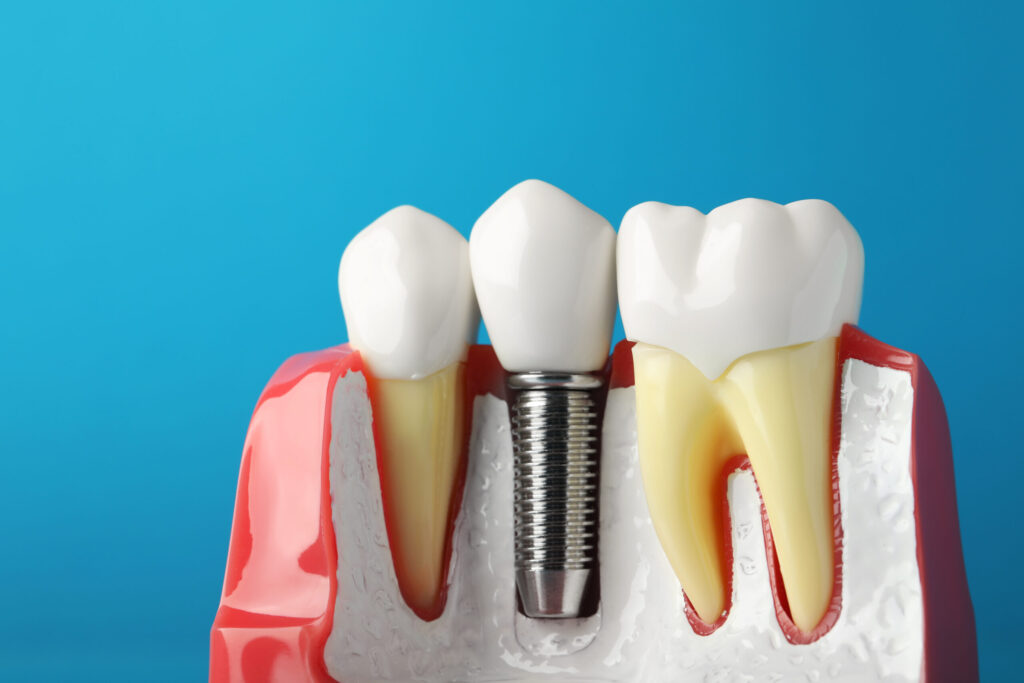 santa rosa dental implants