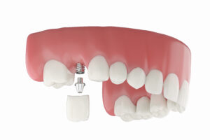 santa rosa dental implants