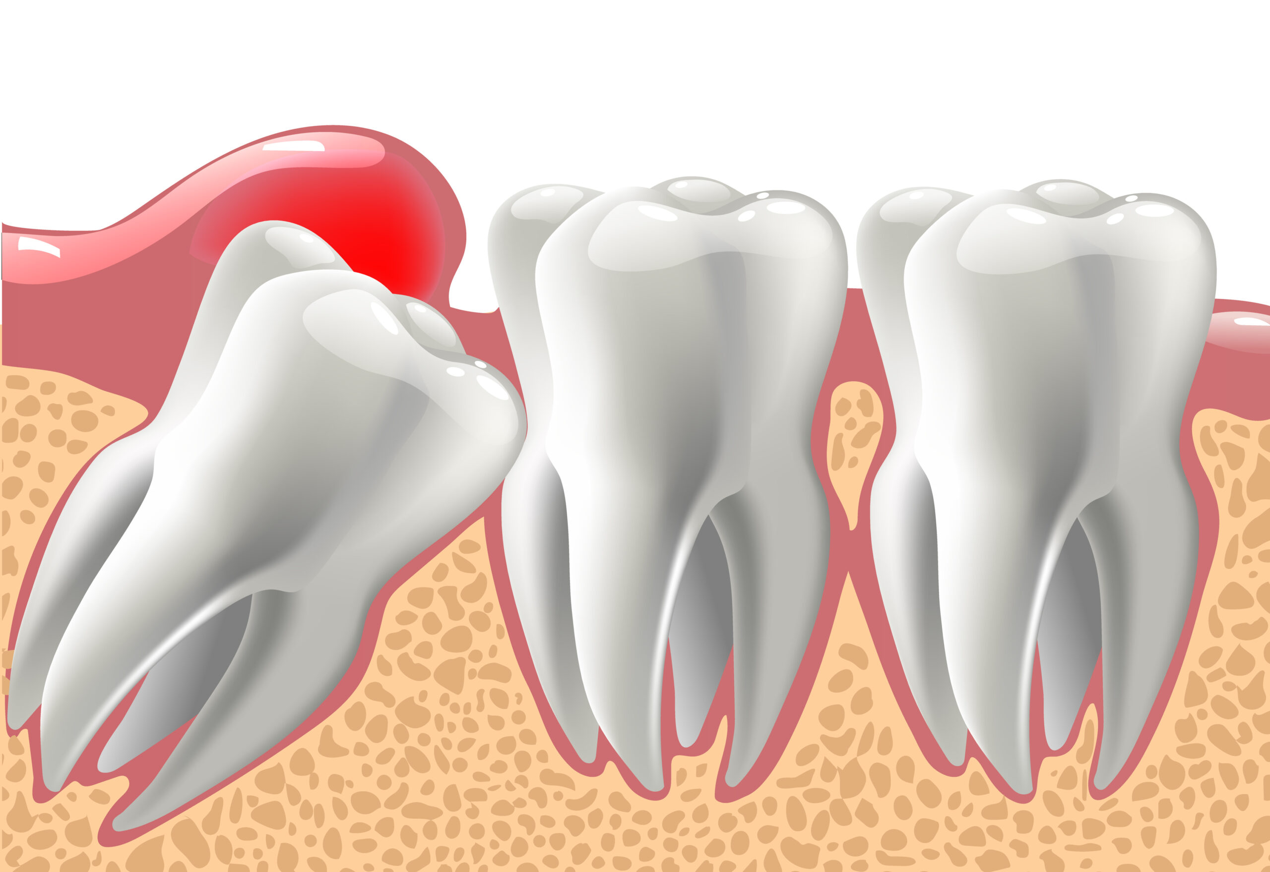 Santa Rosa, CA, dentist offers wisdom tooth removals 