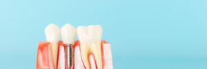 santa rosa dental implants