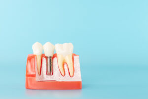 santa rosa dental implants