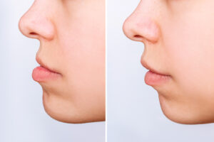 santa rosa jaw surgery