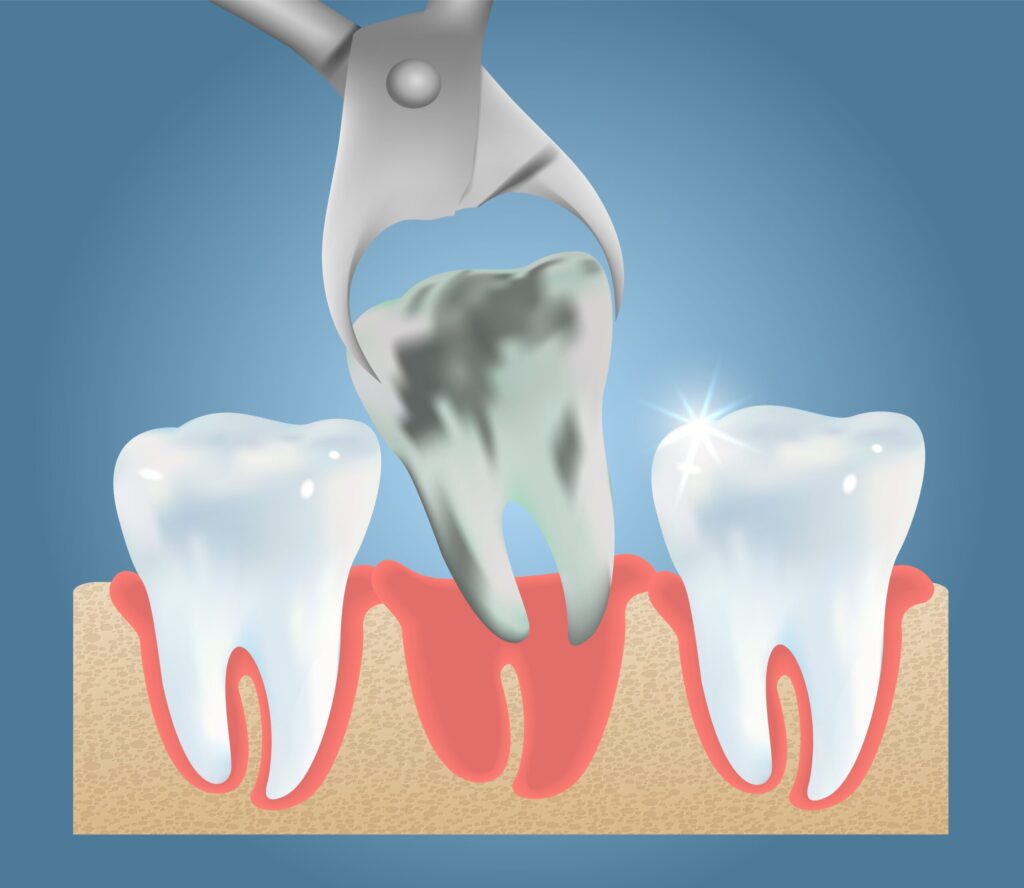 santa rosa tooth extraction