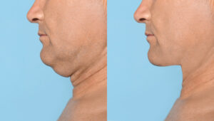 santa rosa jaw surgery