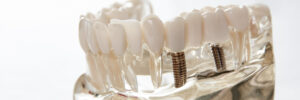 santa rosa dental implants