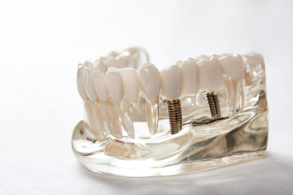 santa rosa dental implants