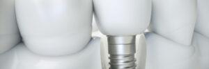 santa rosa dental implants