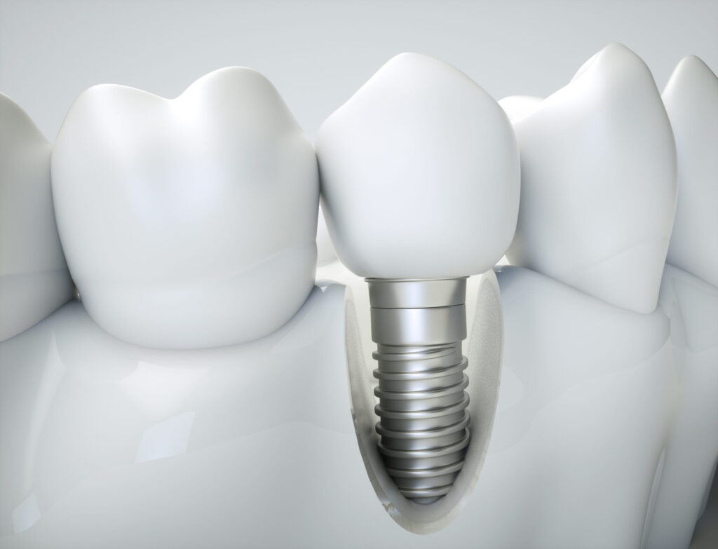 santa rosa dental implants