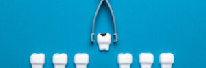 santa rosa tooth extraction