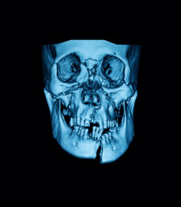 santa rosa facial trauma