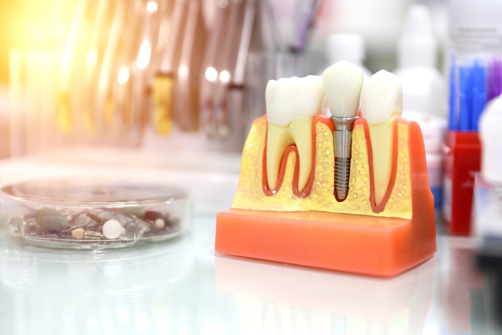 santa rosa dental implants