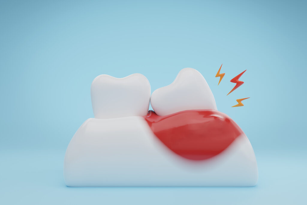 santa rosa wisdom tooth extraction