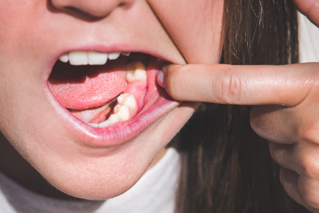 Young woman showing mouth without tooth on lower jaw. Missing tooth. Waiting an implant after tooth extraction. High quality photo
